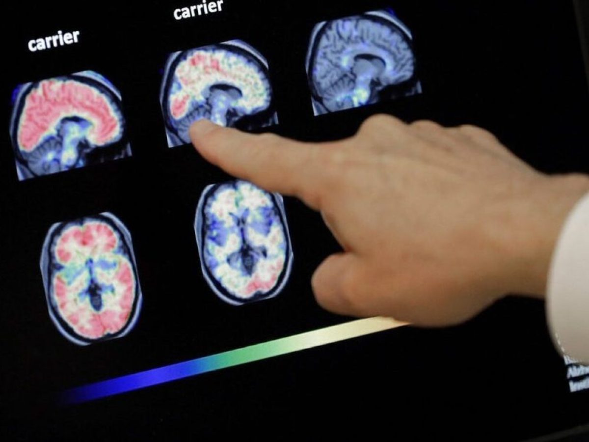 Πιο κοντά από ποτέ στο όνειρο: Επιστήμονες ανέστρεψαν το Αλτσάχαιμερ με νανοσωματίδια