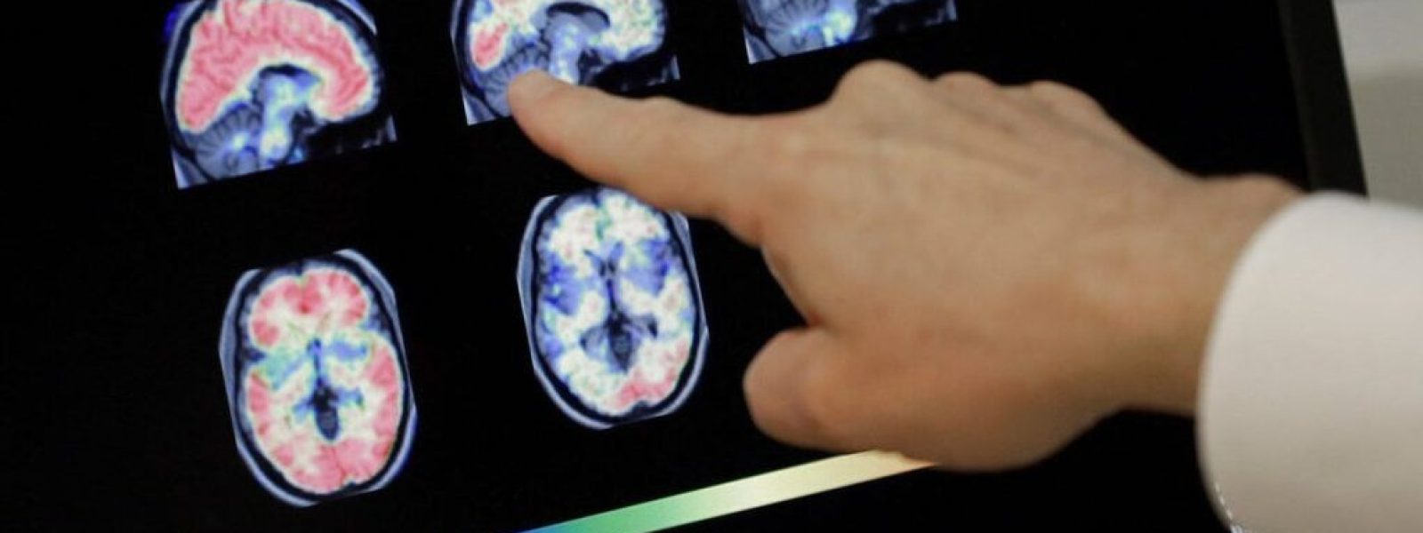 pio-konta-apo-pote-sto Πιο κοντά από ποτέ στο όνειρο: Επιστήμονες ανέστρεψαν το Αλτσάχαιμερ με νανοσωματίδια