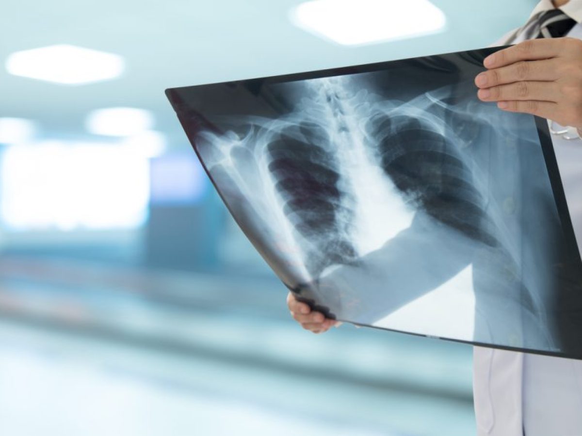 Kαρκίνος του πνεύμονα: Πότε αναμένεται το πιλοτικό πρόγραμμα  προσυμπτωματικού ελέγχου και τι θα περιλαμβάνει