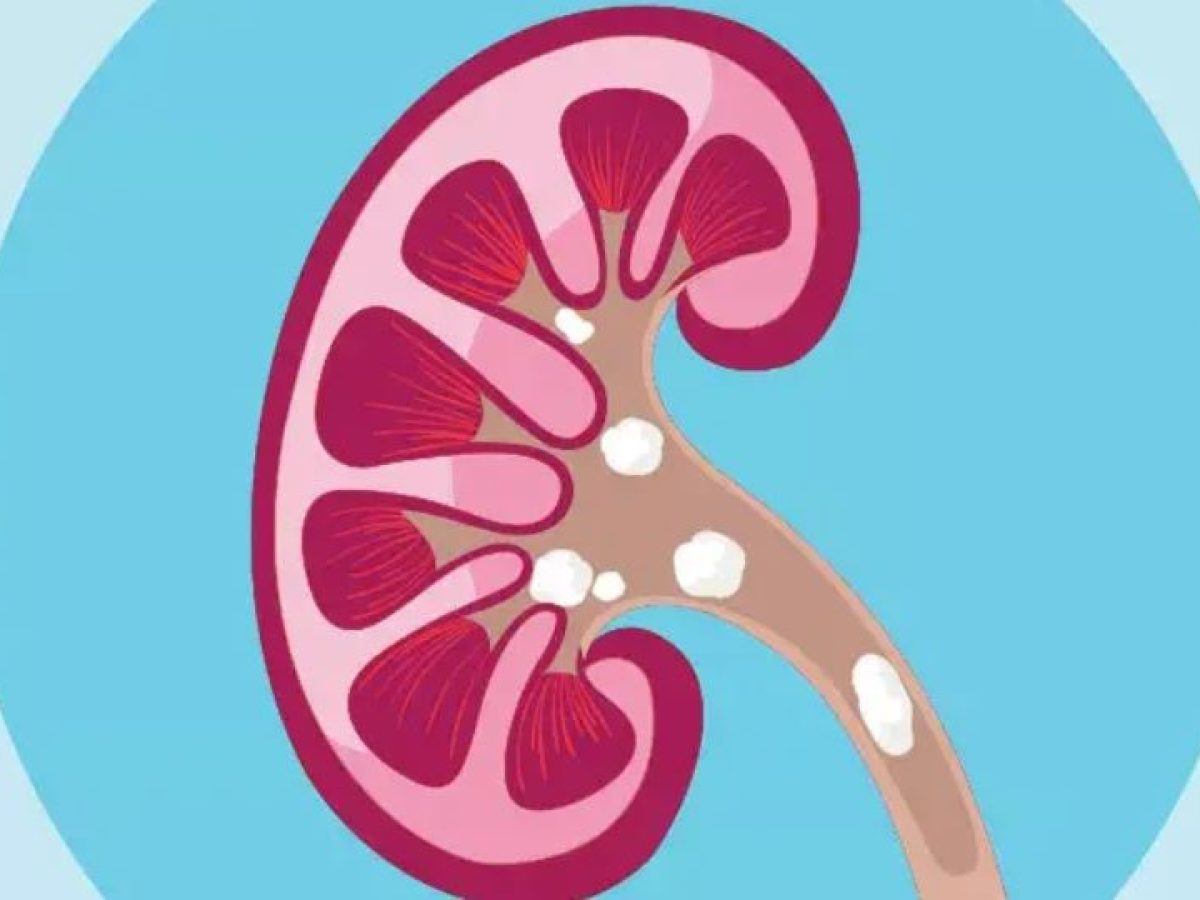 Γιατί το ανθρώπινο σώμα “φτιάχνει πέτρες”;