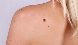 i-elies-sto-derma-ke