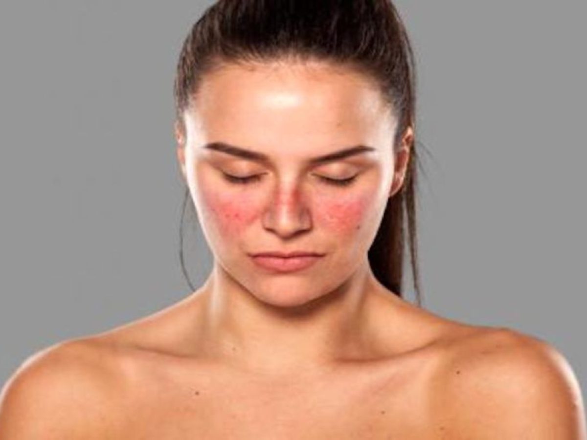 Λύκος: Η ατμοσφαιρική ρύπανση μπορεί να επηρεάσει τον κίνδυνο