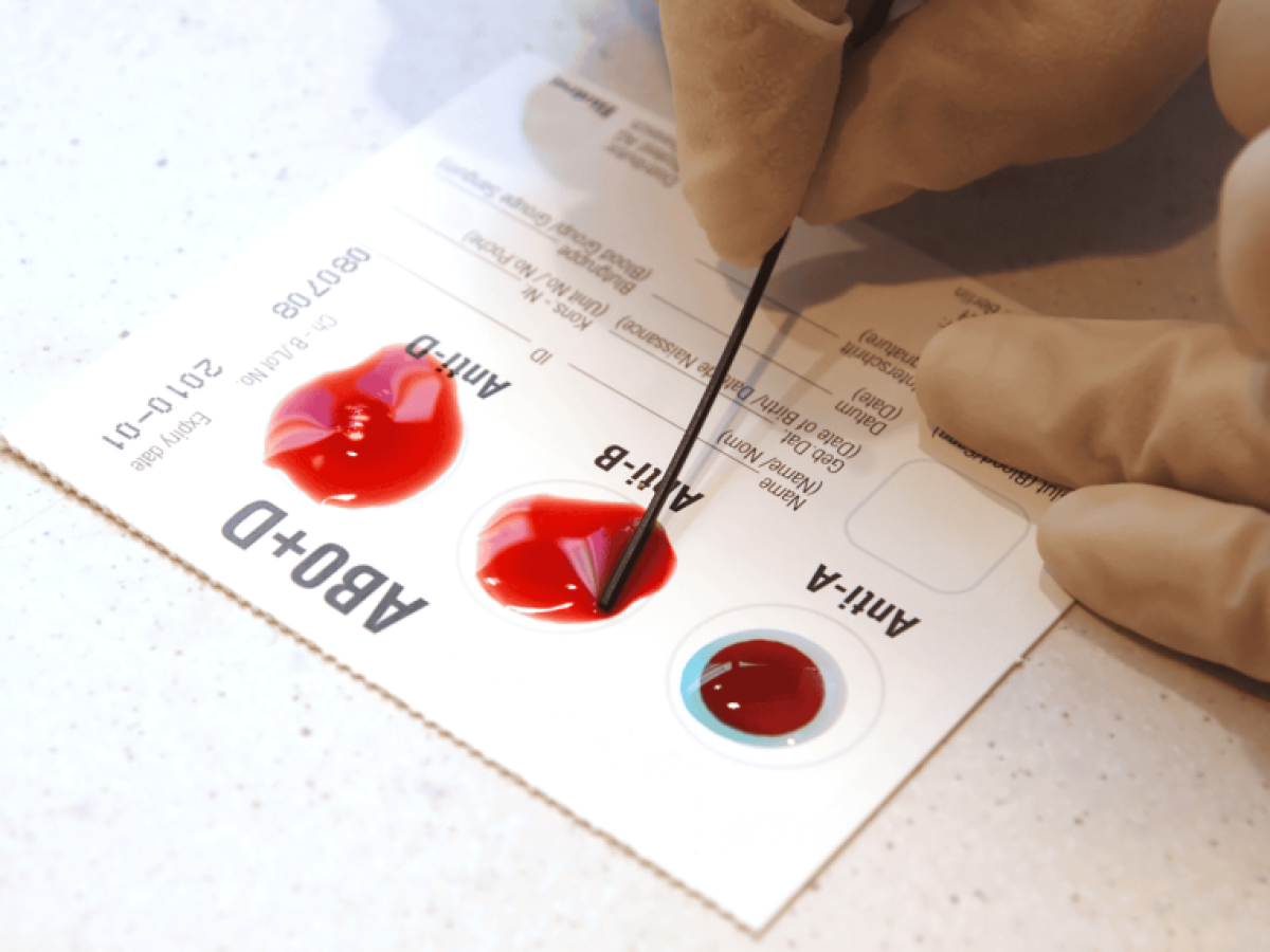 Μεγαλύτερος κίνδυνος για εκδήλωση πρόωρου εγκεφαλικού σε όσους ανήκουν στην ομάδα αίματος Α