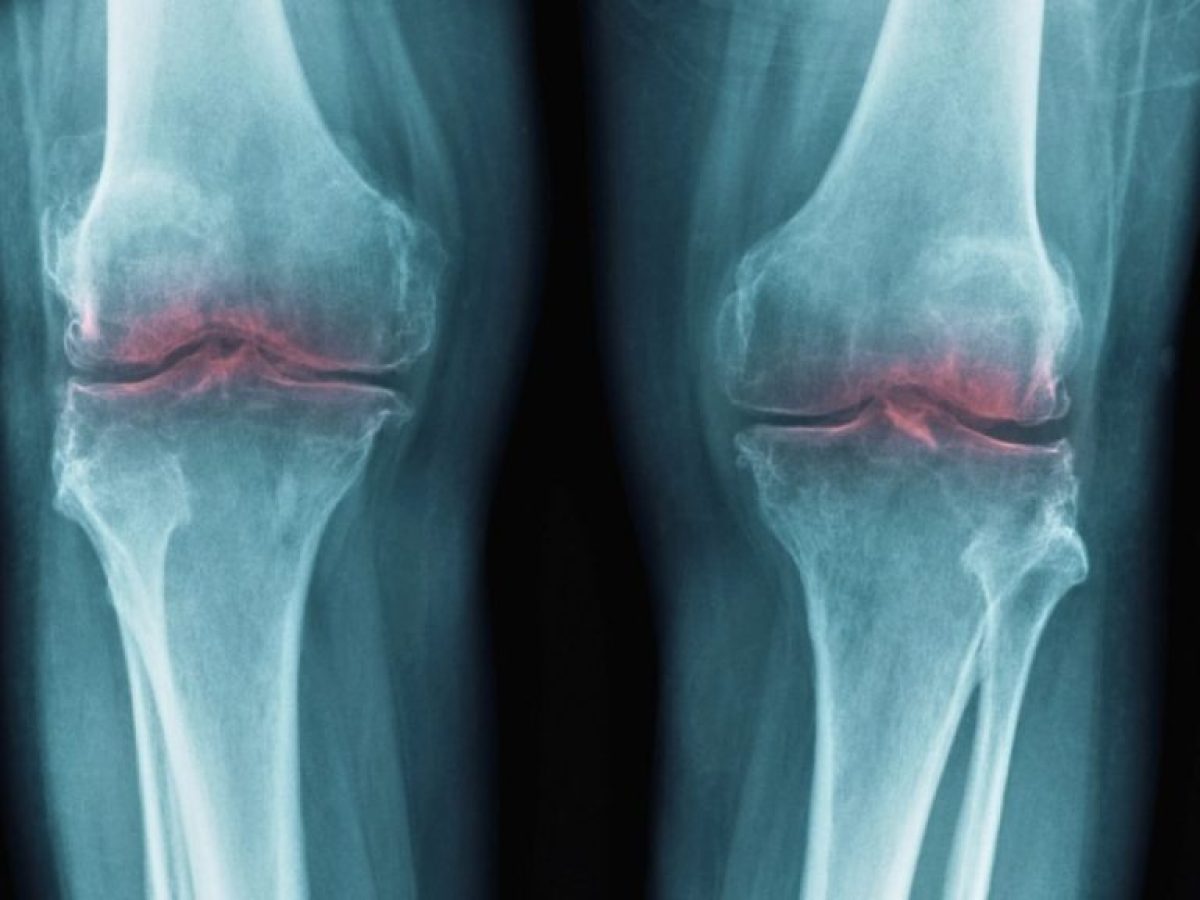 Νέα ανακάλυψη για την αποκατάσταση των γερασμένων αρθρώσεων μπορεί να βοηθήσει στην αντιμετώπιση της οστεοαρθρίτιδας