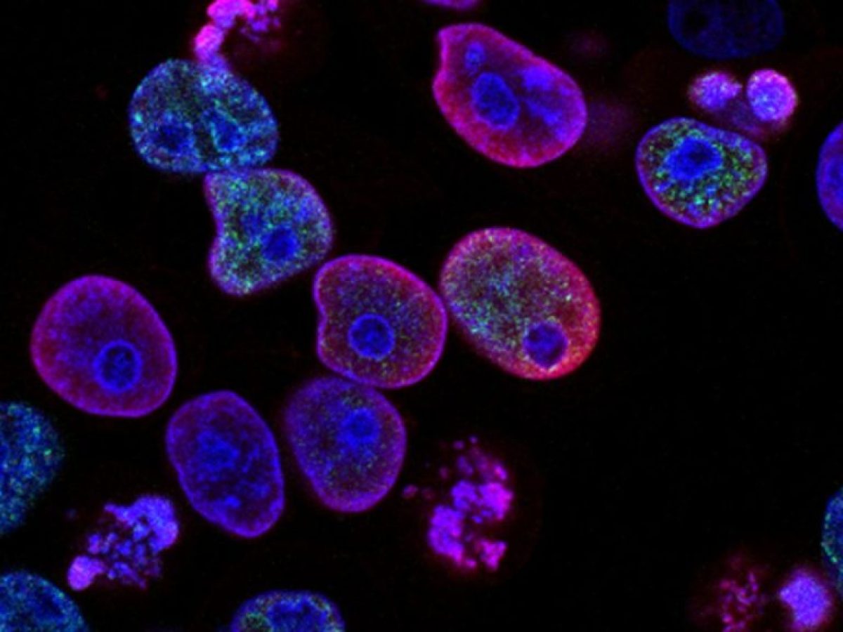 Τεράστια αύξηση στους καρκίνους του γαστρεντερικού – Μεγάλη άνοδος σε νέους ηλικίας 20-30 ετών