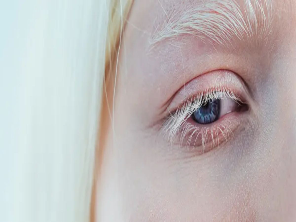 Αλμπινισμός: Η επιστήμη πίσω από την έλλειψη χρώματος