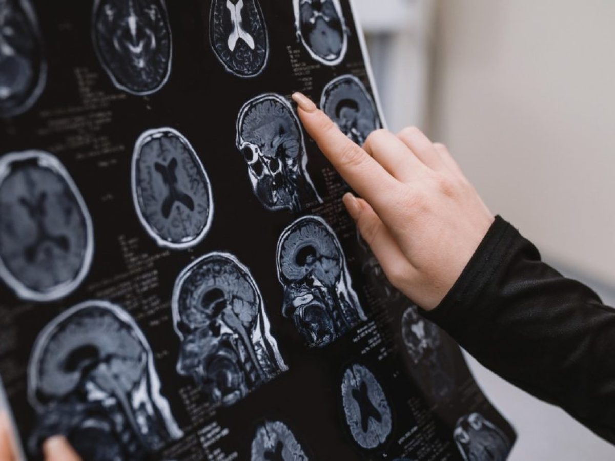 Απότομη αύξηση του σακχάρου στο αίμα συνδέεται με υψηλότερο κίνδυνο Αλτσχάιμερ