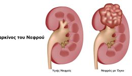 karkinos-nefrou-osa-prepi-na-1