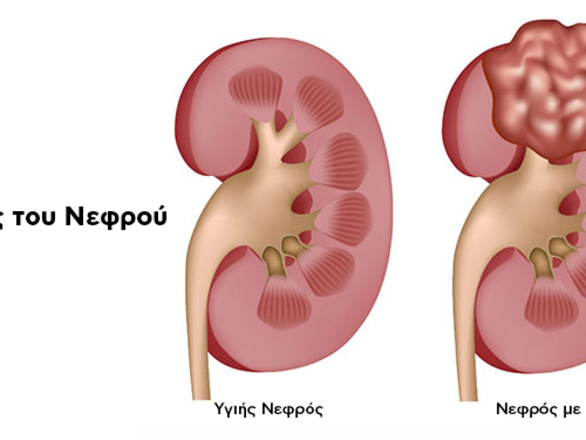 Καρκίνος Νεφρού: Όσα πρέπει να γνωρίζετε για μια σιωπηλή αλλά αντιμετωπίσιμη νόσο