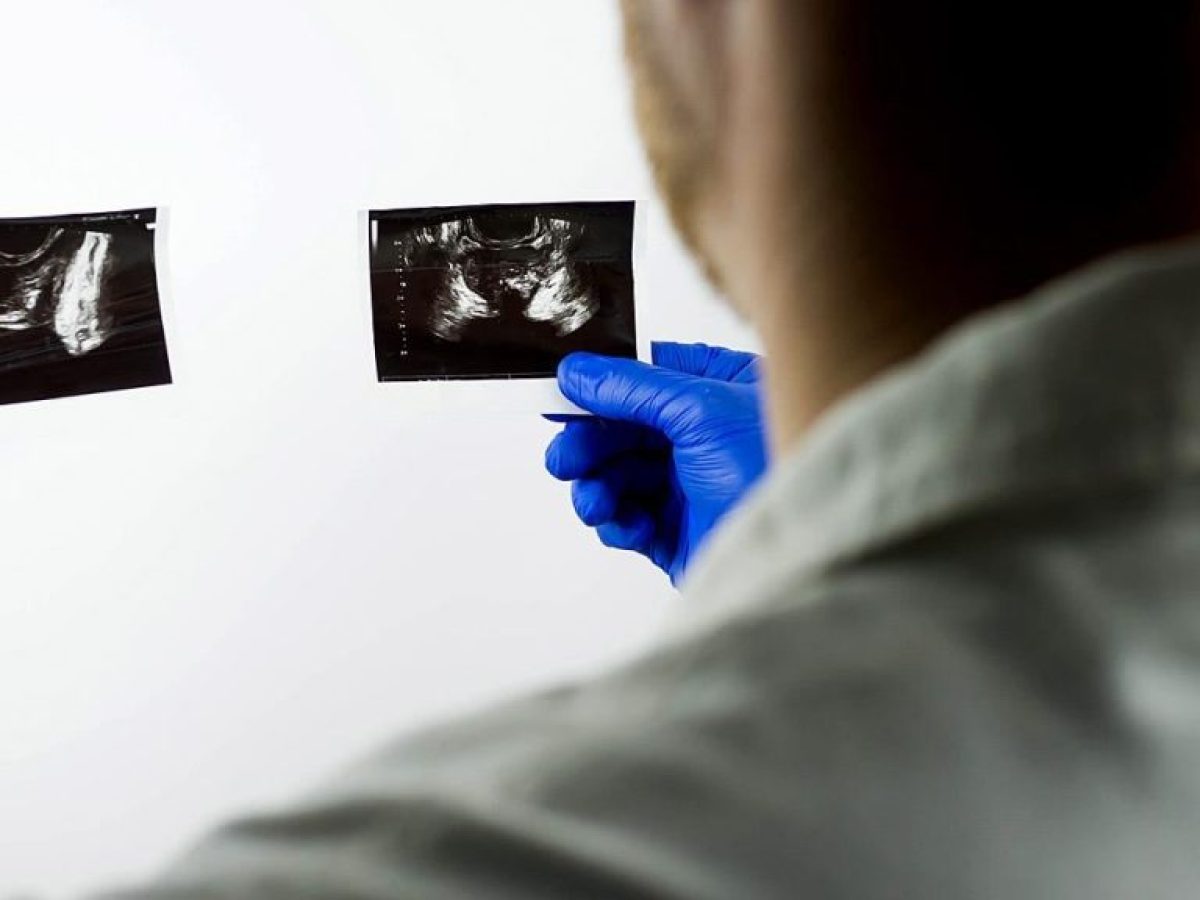 Καρκίνος του προστάτη: Νέο μοντέλο πρόβλεψης κινδύνου θανάτου μετά από PSA