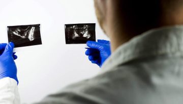 &Kappa;&alpha;&rho;&kappa;ί&nu;&omicron;&sigmaf; &tau;&omicron;&upsilon; &pi;&rho;&omicron;&sigma;&tau;ά&tau;&eta;: &Nu;έ&omicron; &mu;&omicron;&nu;&tau;έ&lambda;&omicron; &pi;&rho;ό&beta;&lambda;&epsilon;&psi;&eta;&sigmaf; &kappa;&iota;&nu;&delta;ύ&nu;&omicron;&upsilon; &theta;&alpha;&nu;ά&tau;&omicron;&upsilon; &mu;&epsilon;&tau;ά &alpha;&pi;ό PSA