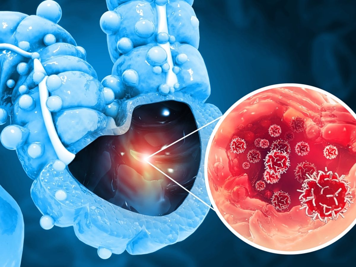 Άλυτο ιατρικό μυστήριο: Ο καρκίνος που χτυπάει τη γενιά του ’90
