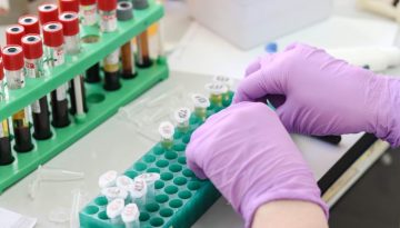 1,4 δισεκατομμύρια άτομα παγκοσμίως έχουν υψηλά επίπεδα λιποπρωτεΐνης Lp(a) – Γιατί είναι σημαντική η εξέταση