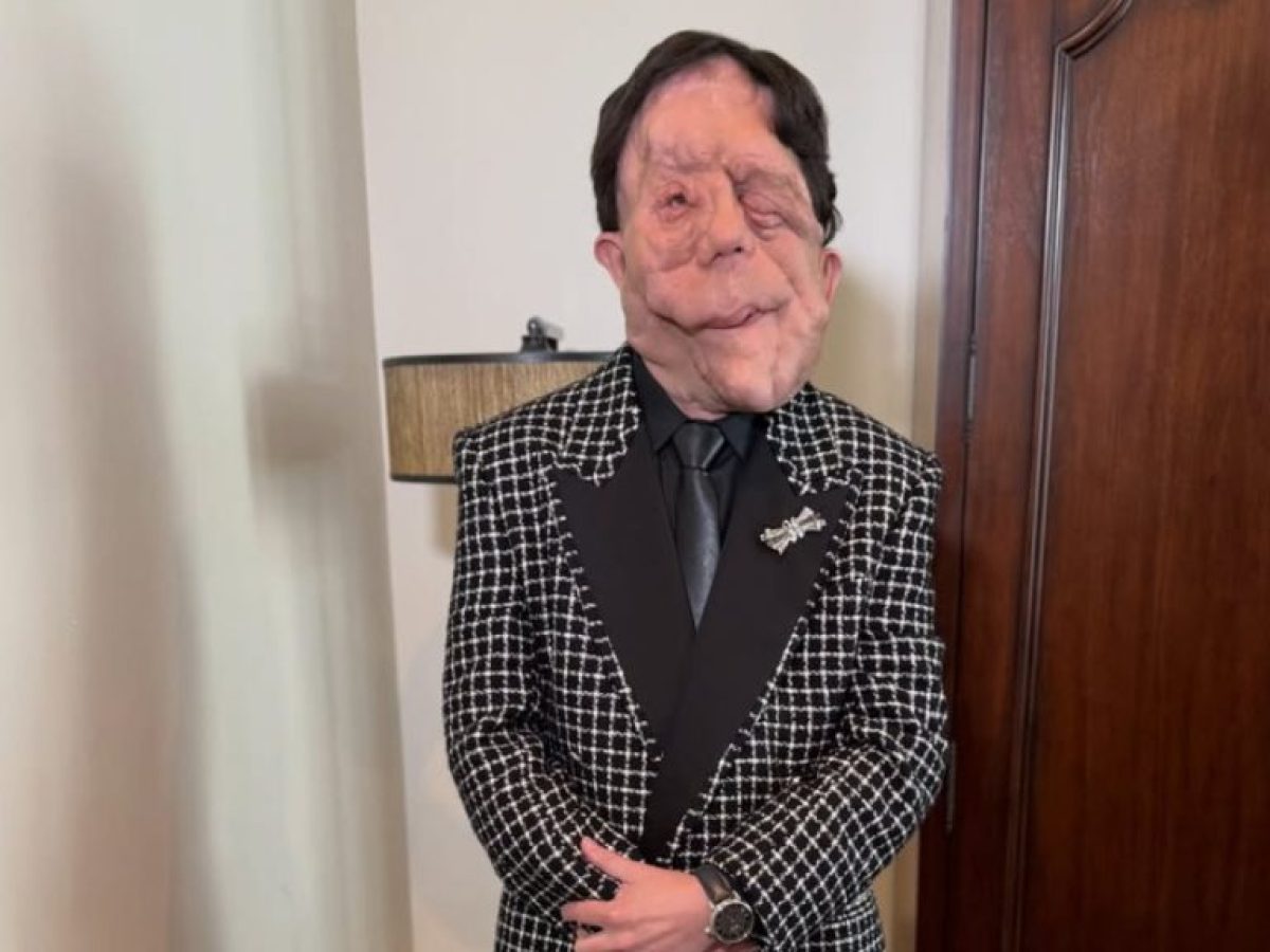 Adam Pearson: Τι είναι η νευροϊνωμάτωση από την οποία πάσχει – Η διάγνωση & οι θεραπευτικές επιλογές