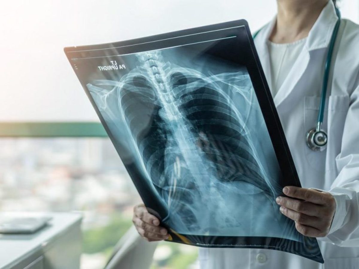 ΕΜΑ: Νέα θεραπεία για υποτροπιάζοντα μικροκυτταρικό καρκίνο του πνεύμονα