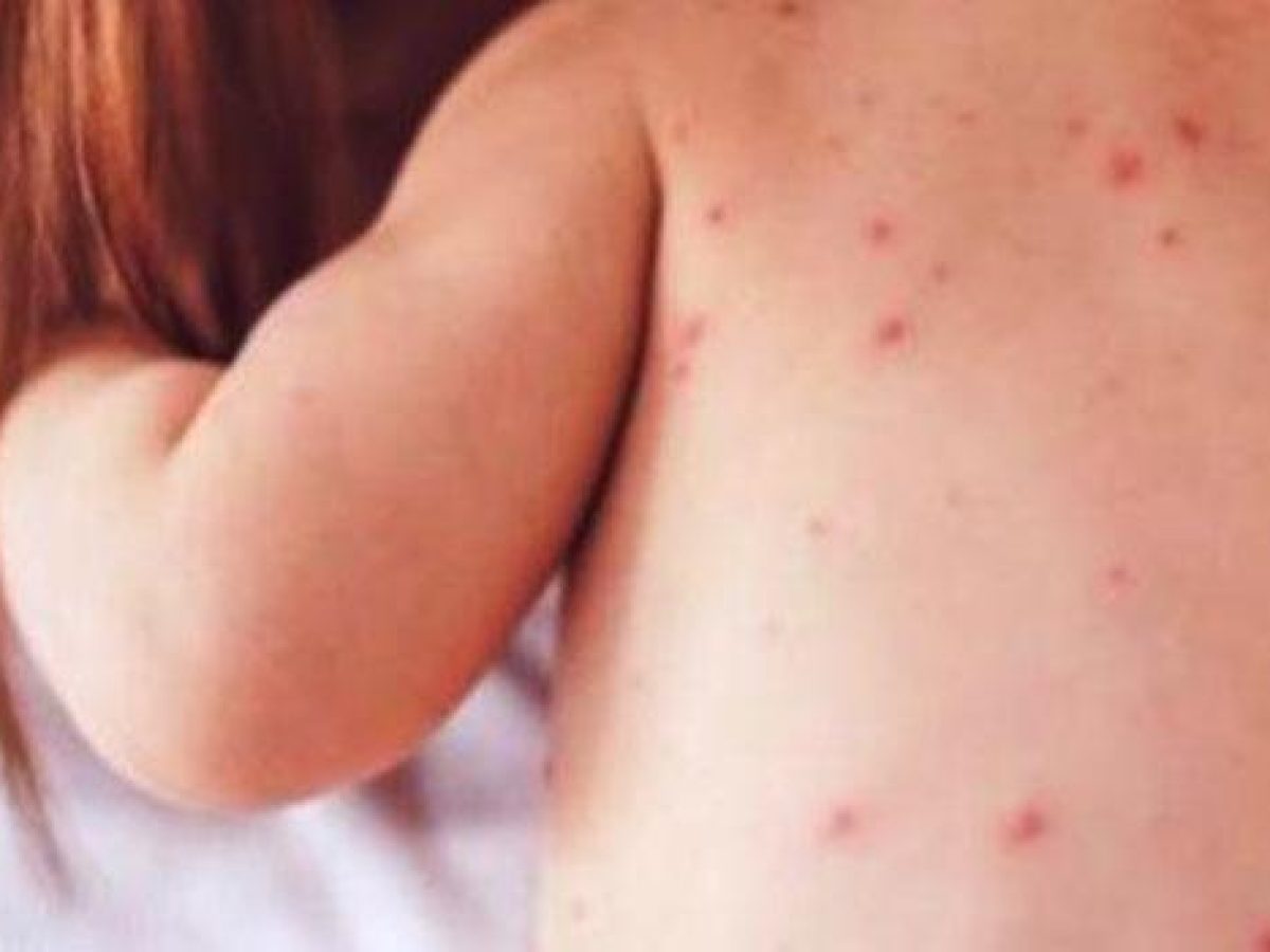 ΕΟΔΥ: Η ιλαρά συνεχίζει να προκαλεί σοβαρές επιπλοκές και θανάτους στην Ευρώπη  – Κρίσιμος ο εμβολιασμός