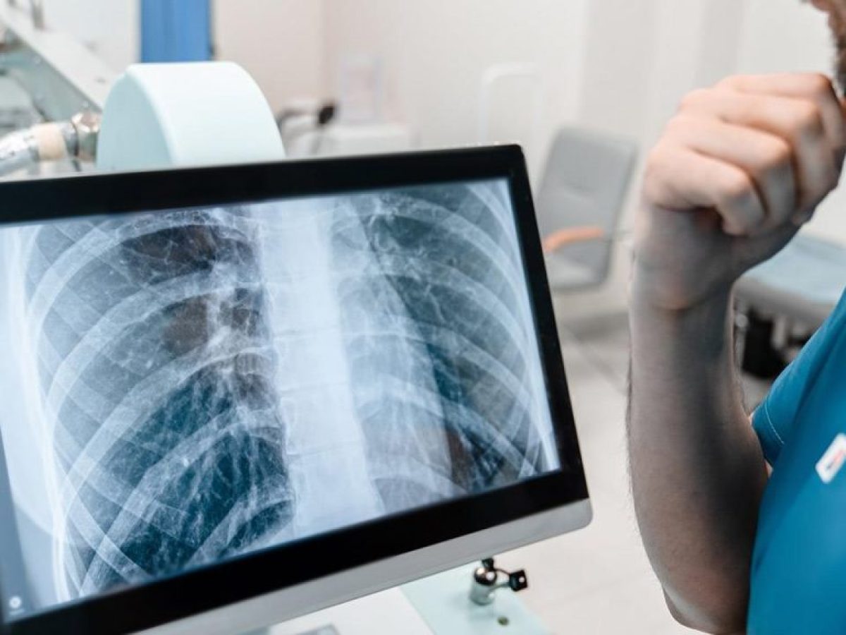 Φυματίωση – ECDC: Αδιάγνωστο 1 στα 5 κρούσματα στην Ευρώπη – Τι γίνεται στην Ελλάδα