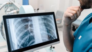 Φυματίωση – ECDC: Αδιάγνωστο 1 στα 5 κρούσματα στην Ευρώπη – Τι γίνεται στην Ελλάδα