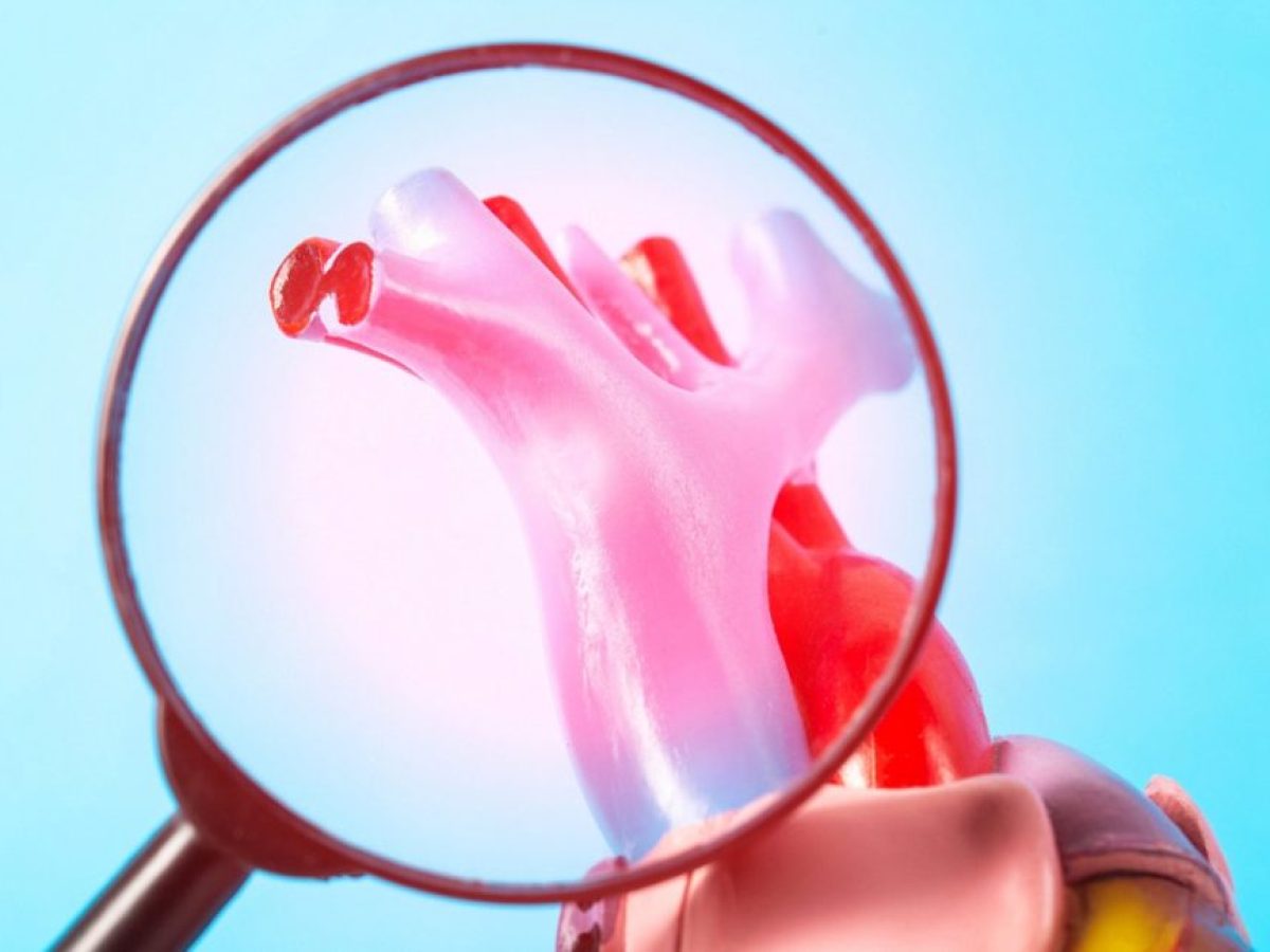 Φραγμένες αρτηρίες: Συμπτώματα και θεραπεία της αθηροσκλήρωσης