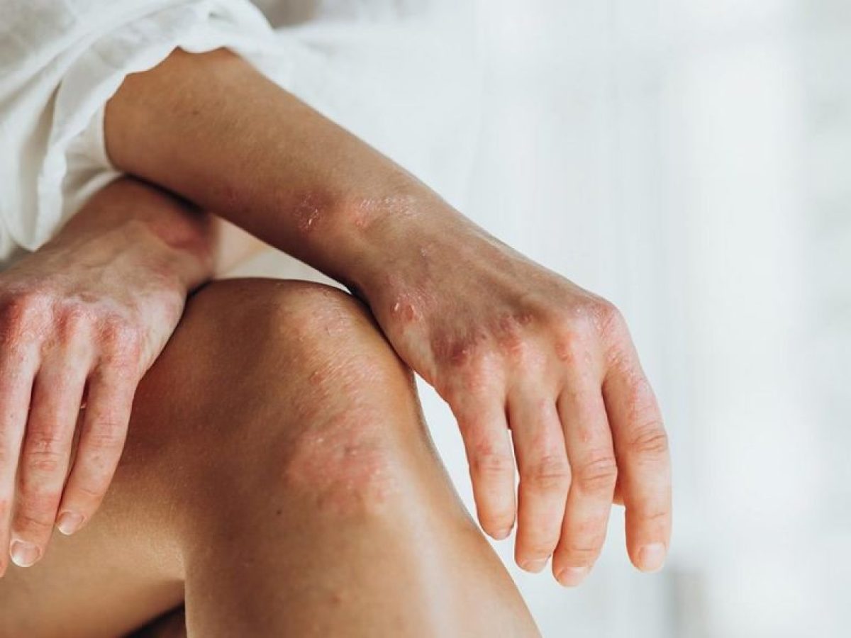 Η ψωρίαση εμποδίζει την ανάπτυξη καρκίνου του δέρματος