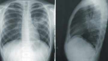 Καρκίνος του πνεύμονα: Μπορεί να εμφανιστεί και σε ανθρώπους που δεν κάπνισαν ποτέ στη ζωή τους 