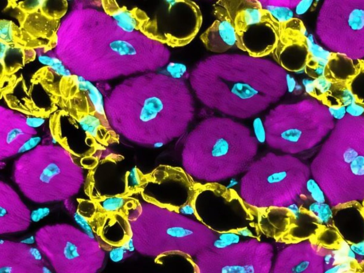 Περιφερική αρτηριακή νόσο: O ρόλος του λίπους μέσα στον μυϊκό ιστό