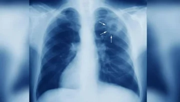 Προειδοποίηση ΠΟΥ: Η φυματίωση επιστρέφει πιο ανθεκτική – Τι συμβαίνει στην Ευρώπη