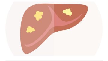 Τι πρέπει να γνωρίζετε για τη λιπώδη νόσο του ήπατος