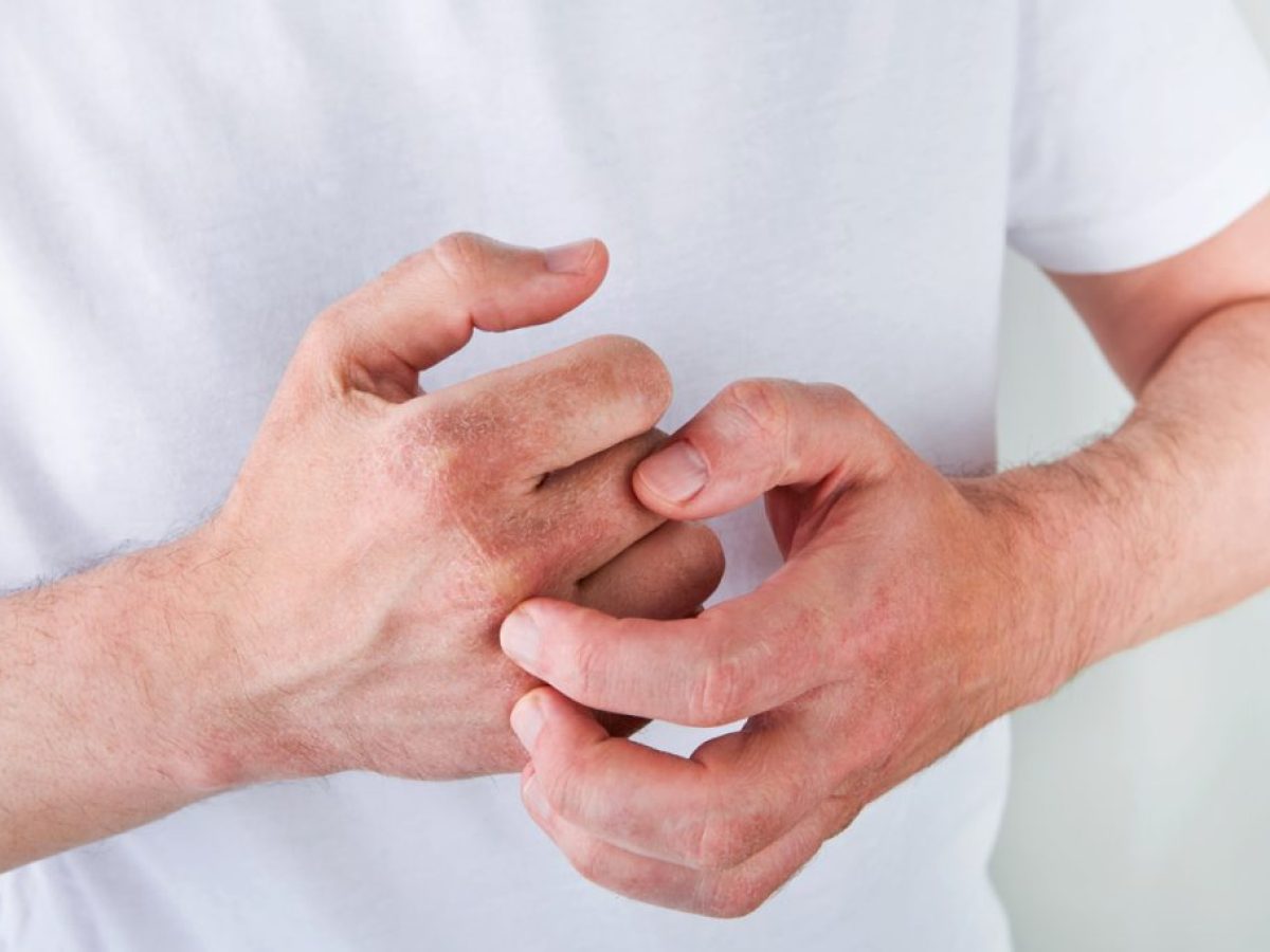 Το στρες πυροδοτεί το έκζεμα – Οι επιστήμονες βρήκαν επιτέλους το γιατί