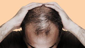Φυτικός ορός υπόσχεται λύση στην τριχόπτωση: Τι έδειξε η πρώτη μελέτη;