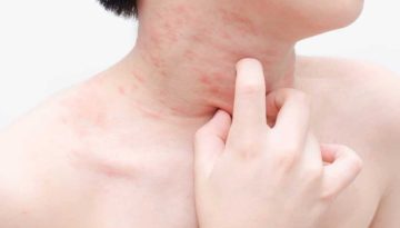 Καλωσορίσατε στην εποχή των αλλεργιών: Όλα όσα πρέπει να γνωρίζετε