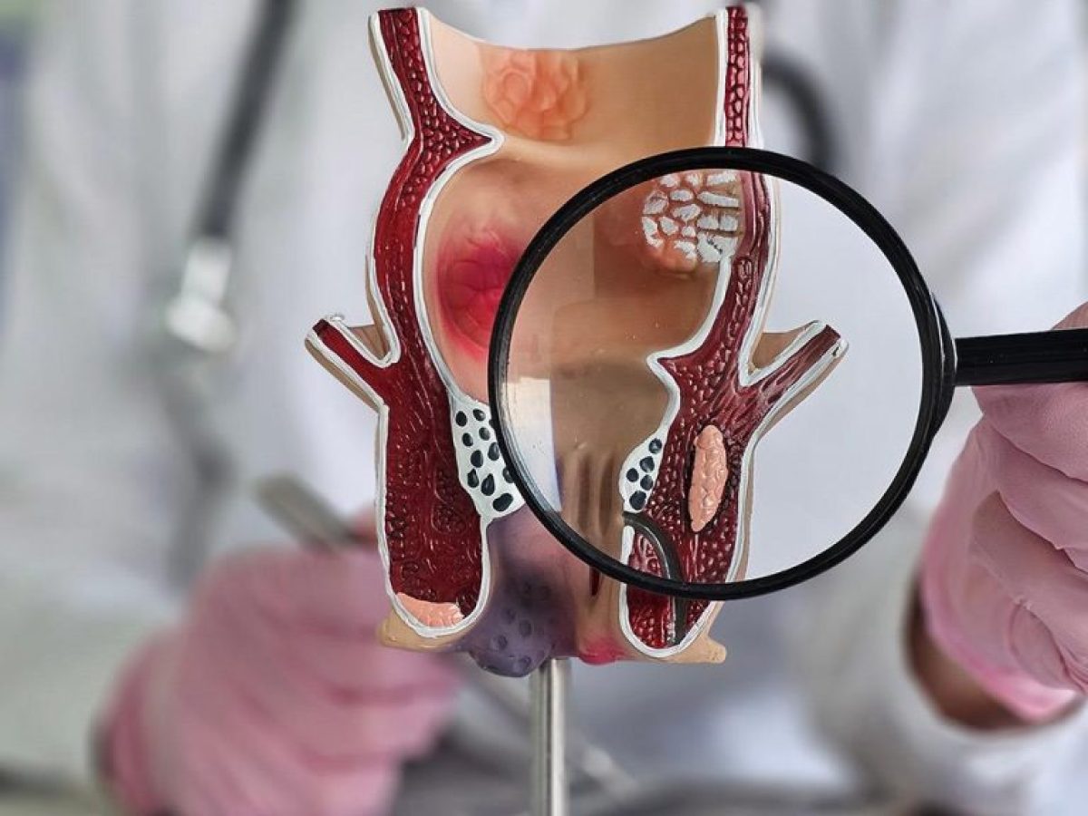 Πρώτος αναστολέας checkpoint για τον καρκίνο του πρωκτού