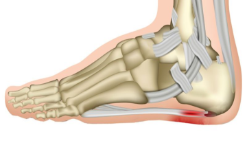 Άκανθα πτέρνας: Τι είναι, γιατί εμφανίζεται και πώς αντιμετωπίζεται