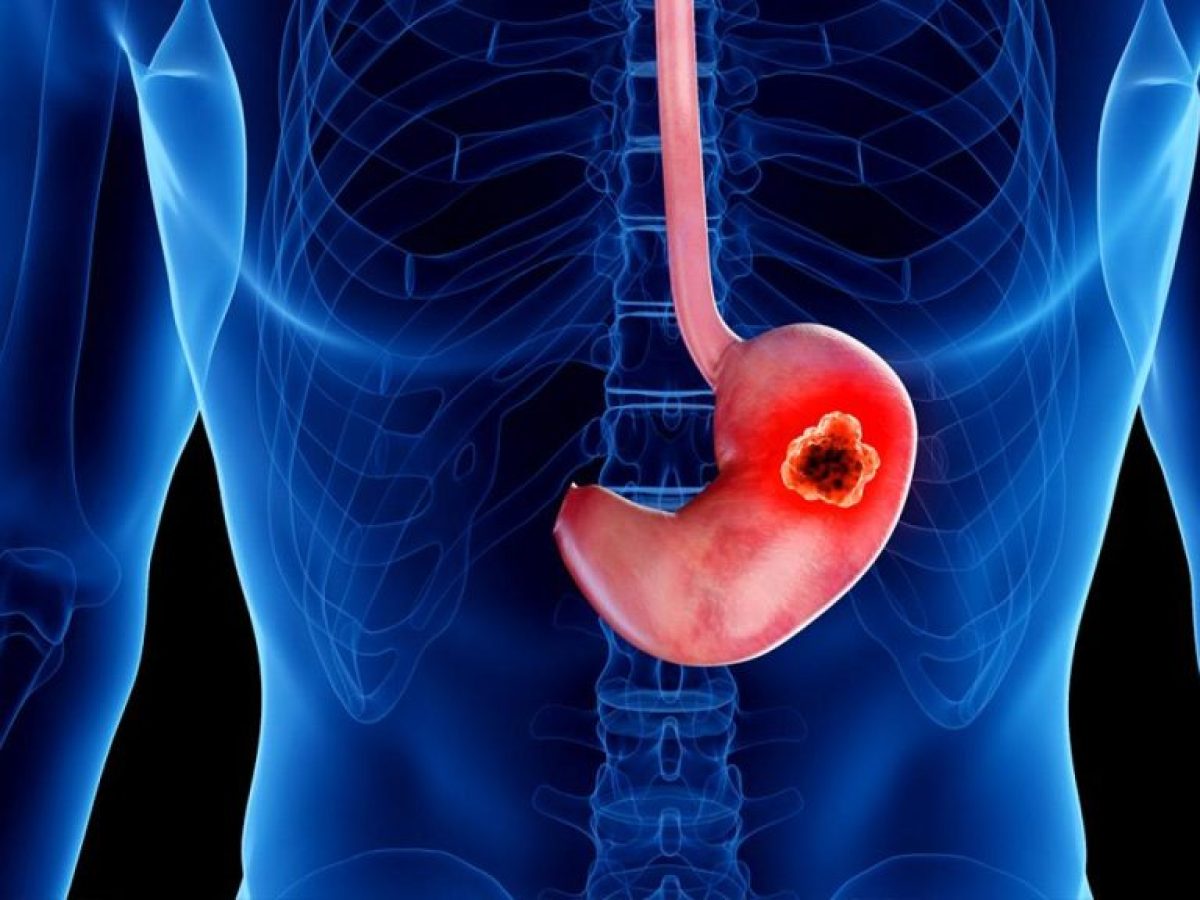 ‘Ερευνα συνδέει τα στοματικά βακτήρια με τον καρκίνο του στομάχου