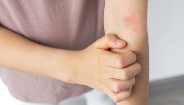 SOS για τις αλλεργικές αντιδράσεις – Πώς τις διαχειριζόμαστε