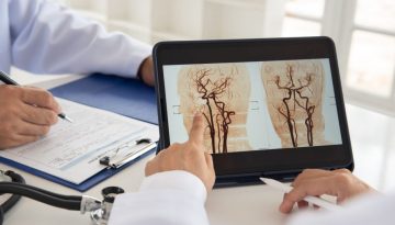 Αυτό το συνηθισμένο είδος εγκεφαλικού μπορεί να μην οφείλεται σε φραγμένες αρτηρίες
