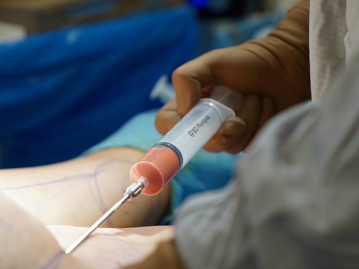 Επεμβάσεις ομορφιάς χωρίς γιατρούς: Νεκροί, σηψαιμία και σοκαριστικές αποκαλύψεις για τα παράνομα fillers