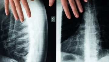 &Tau;&alpha; &omicron;&sigma;&tau;ά &epsilon;&pi;&iota;&kappa;&omicron;&iota;&nu;&omega;&nu;&omicron;ύ&nu; &mu;&epsilon; &tau;&omicron; &upsilon;&pi;ό&lambda;&omicron;&iota;&pi;&omicron; &sigma;ώ&mu;&alpha; &gamma;&iota;&alpha; &nu;&alpha; &upsilon;&pi;&omicron;&sigma;&tau;&eta;&rho;ί&xi;&omicron;&upsilon;&nu; &tau;&eta; &sigma;&upsilon;&nu;&omicron;&lambda;&iota;&kappa;ή &upsilon;&gamma;&epsilon;ί&alpha; &ndash; HealthyLiving.gr